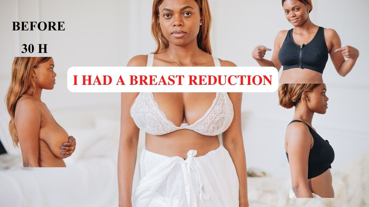 Dadou~chic My Breast Reduction Story My Results